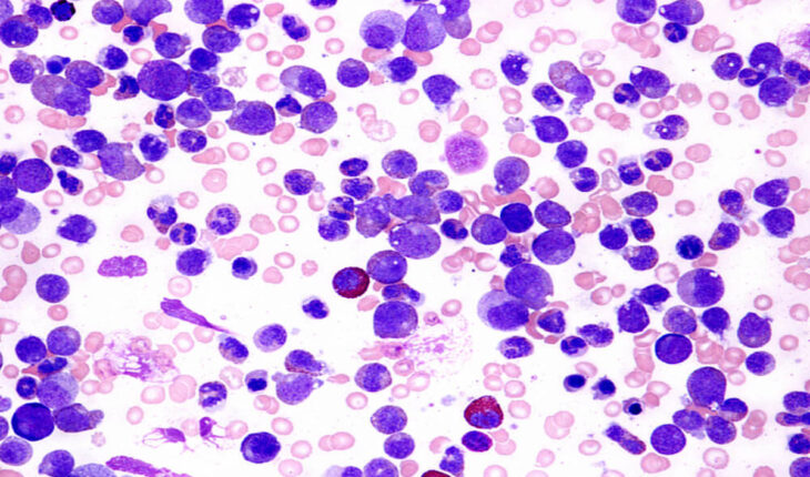 Chronic Myeloid Leukemia: Causes, Symptoms & Treatment