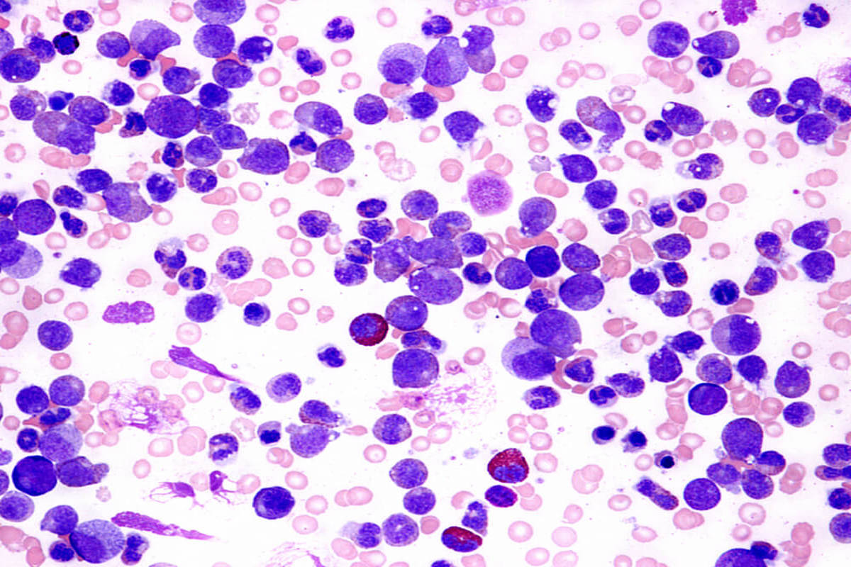 Chronic Myeloid Leukemia blood cells under microscope