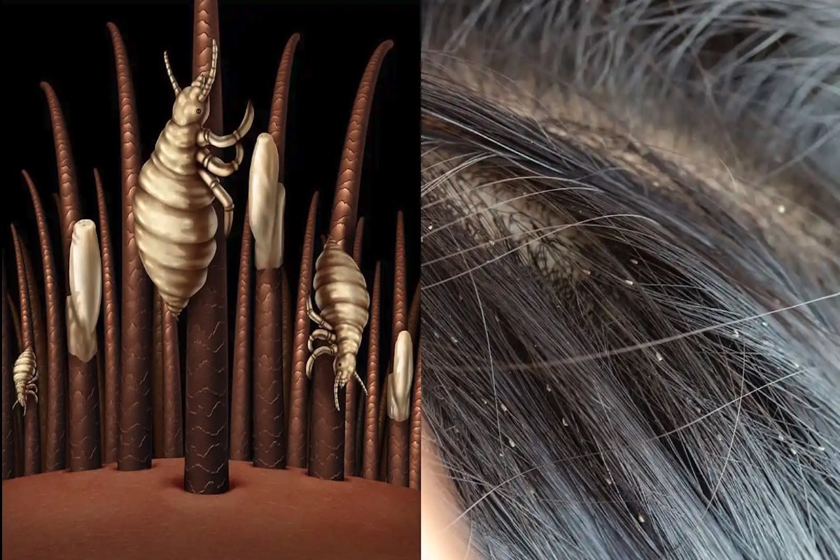 head lice and nits in brown hair