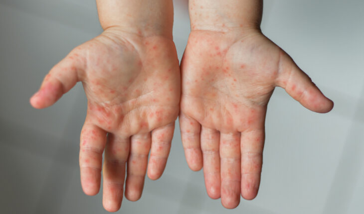 Hand Foot Mouth Disease: Causes, Symptoms & Treatment