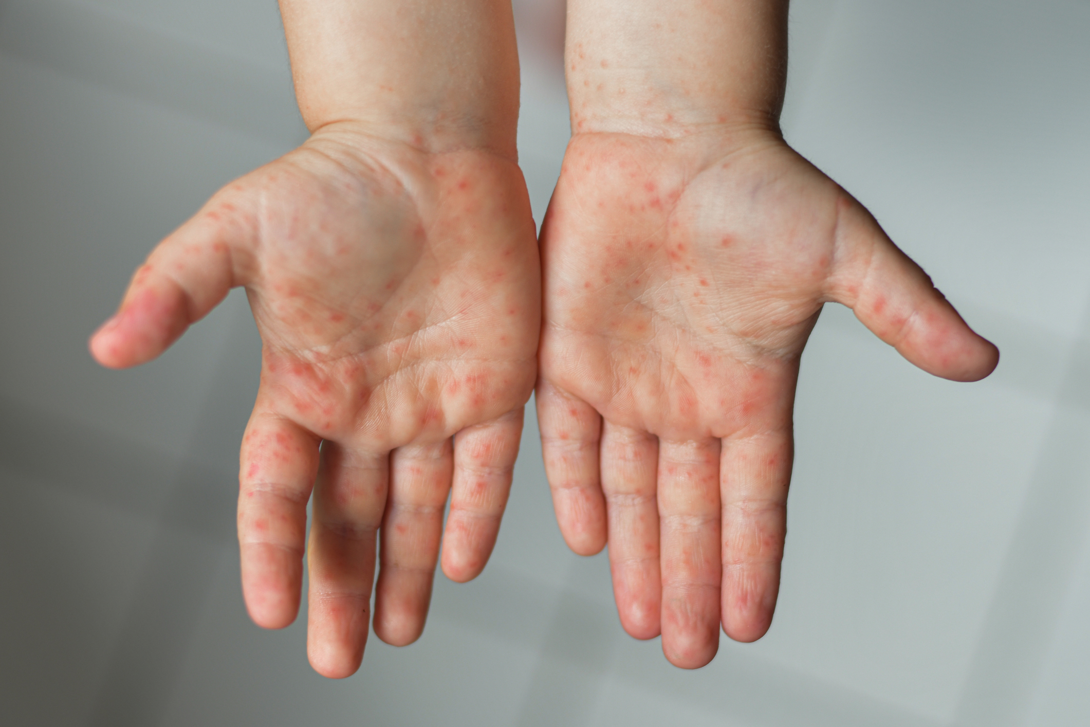 Hand Foot and Mouth Disease. Rash on the insides of a child's hands