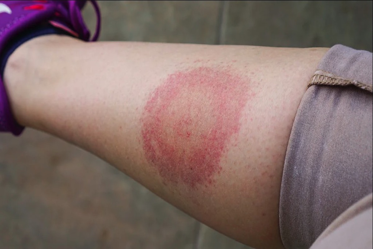 Lyme Disease Causes, Symptoms & Treatment Options