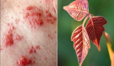Poison Ivy Rash: Causes, Symptoms & Treatment Options