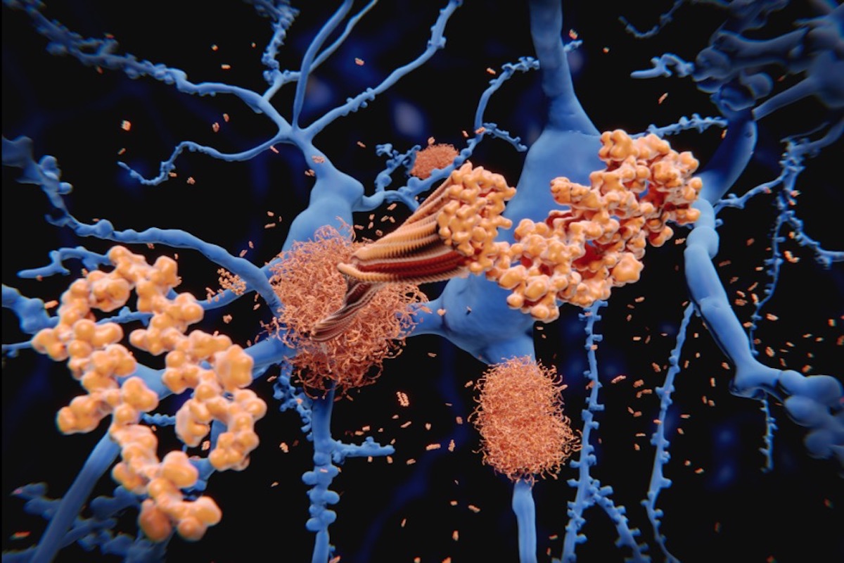 Amyloidosis