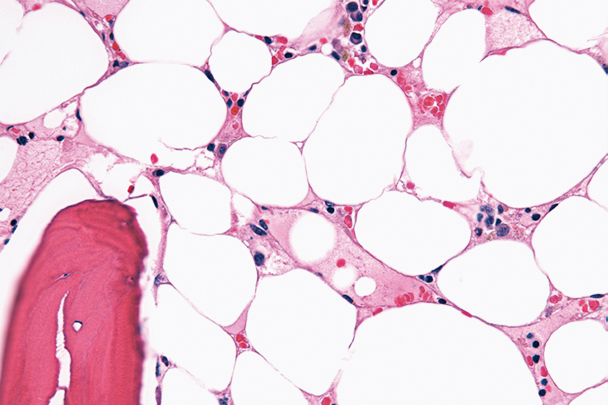 Aplastic Anemia: Causes, Symptoms & Treatment Options