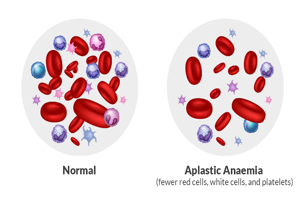 how it should be vs. aplastic anemia