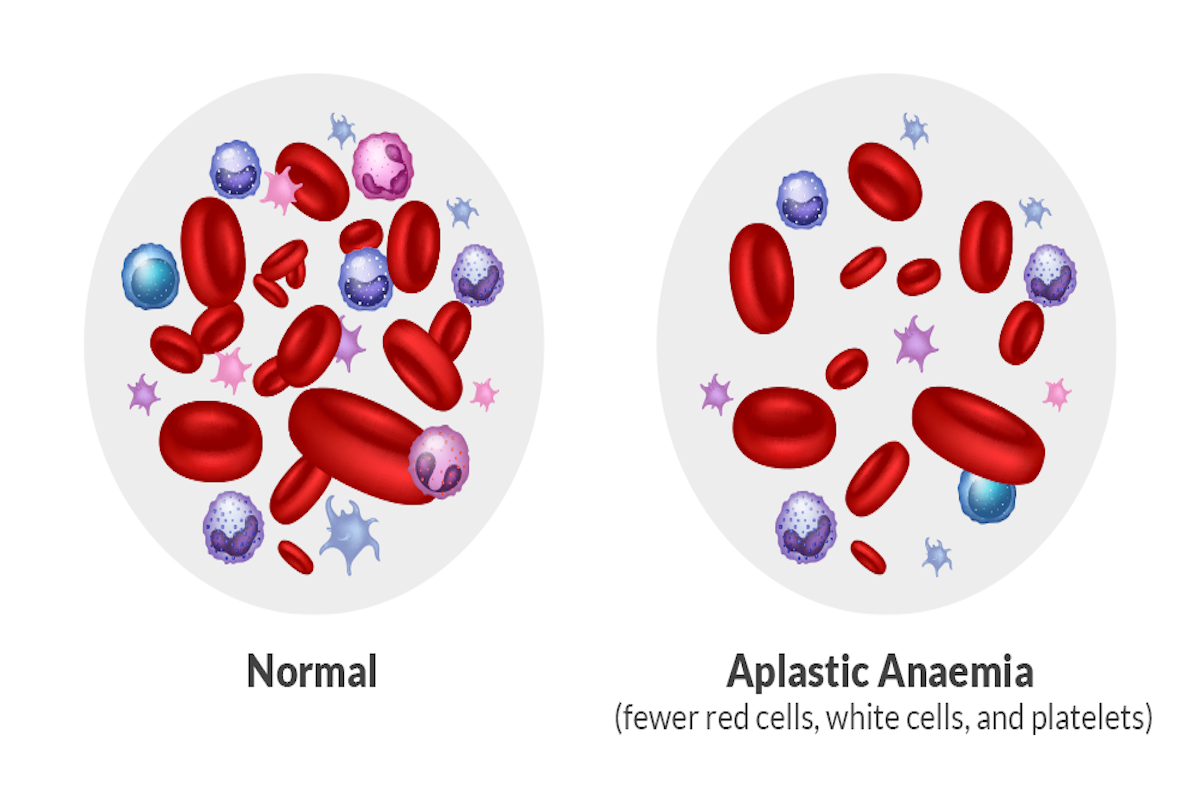 How It Should Be Vs Aplastic Anemia