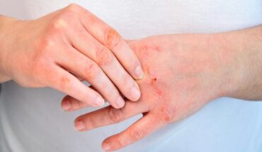 Atopic Dermatitis: Causes, Symptoms & Treatments