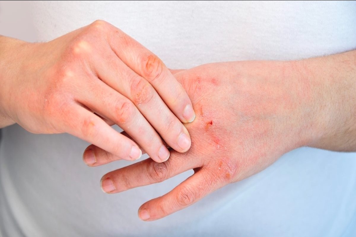 Atopic Dermatitis on hands