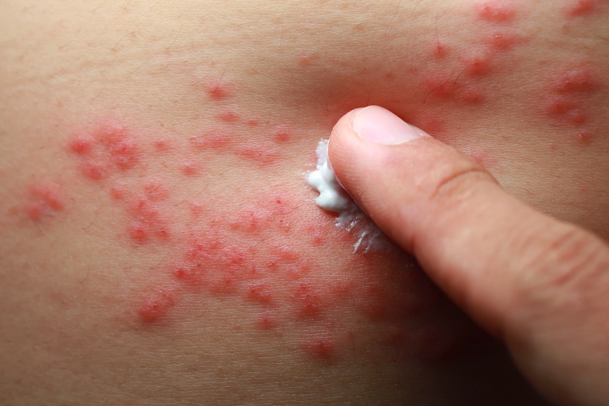 atopic dermatitis on skin