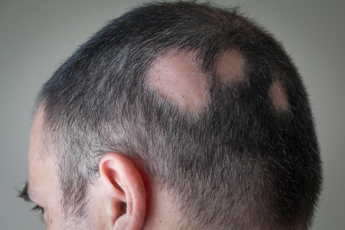 Androgenetic alopecia (male or female pattern baldness). Hair loss