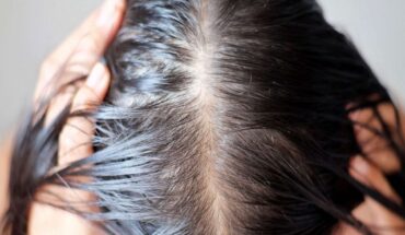 Hair Loss: Causes, Treatment Options & When to Visit Your Doctor