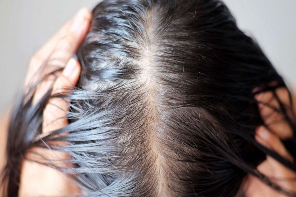 picture of a woman scalp with thinning hair. Hair loss