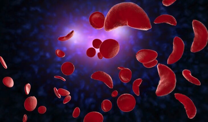 Sickle Cell Anemia: Causes, Symptoms and Treatment Options
