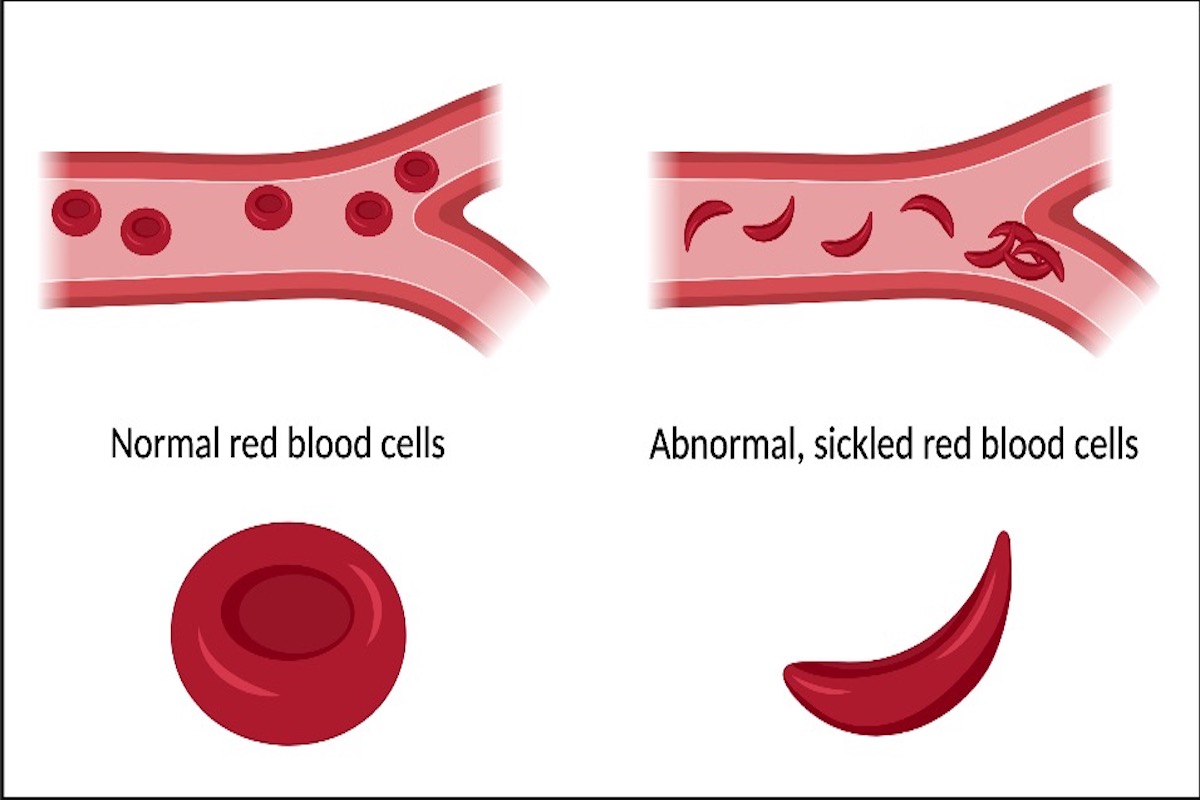 Difference between normal red blood cells and abnormal sickled red blood cells. Sickle cell anemia.