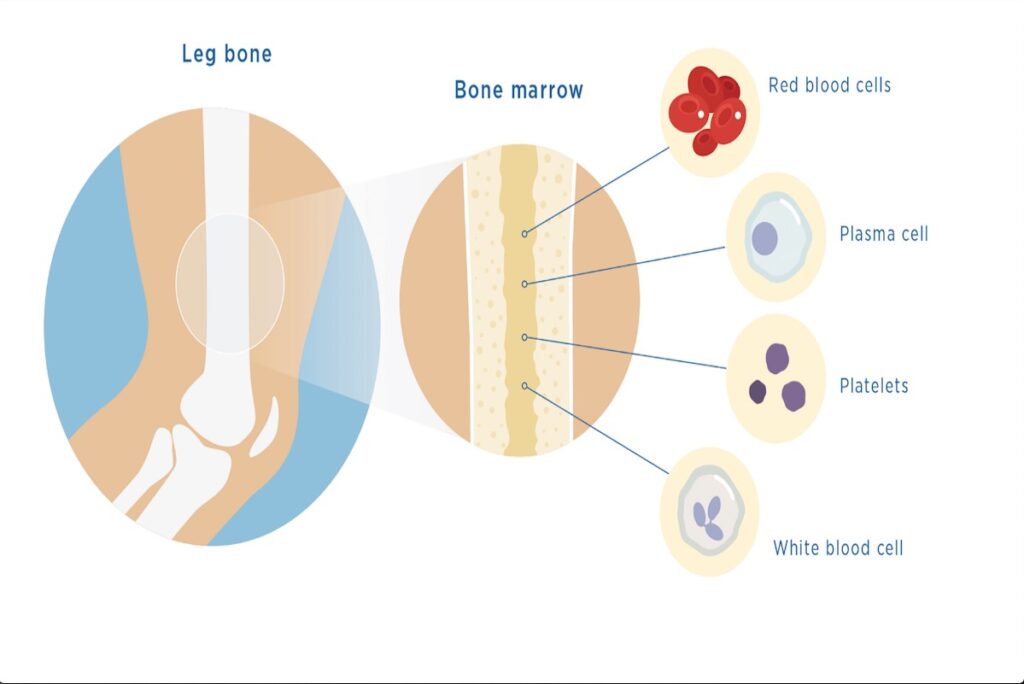 Plasma Cell Cancers Types Symptoms And Treatments