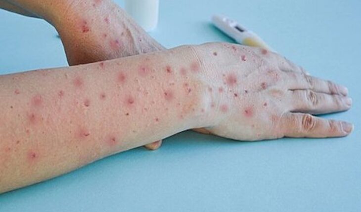 Chickenpox: Causes, Symptoms & Treatment Options