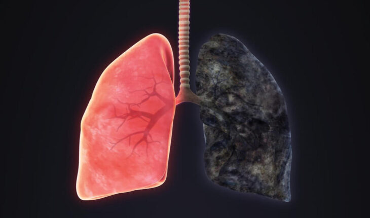 Emphysema: Causes, Symptoms & Treatment Options