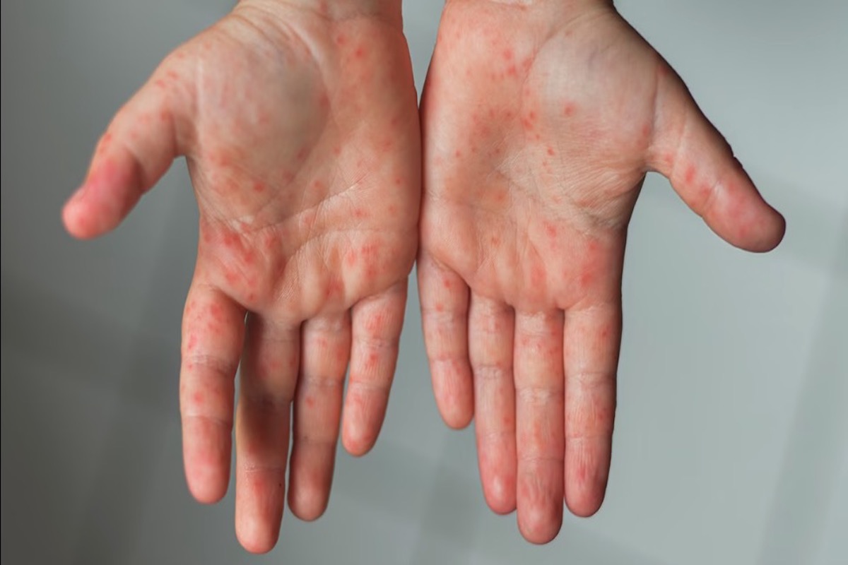 Measles Rash on Child Hands