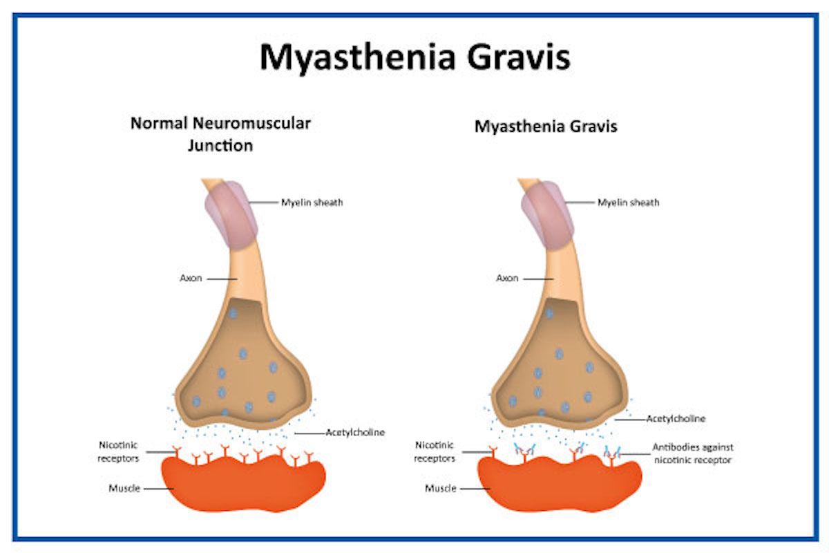 myasthenia gravis vs normal neuromuscular junction