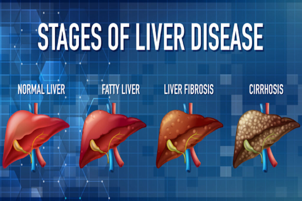 What Causes Liver Cirrhosis In Babies