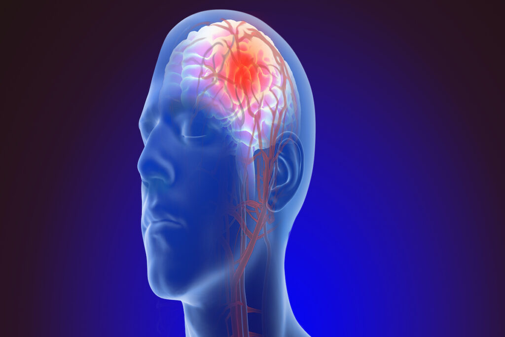 Brain Aneurysm Causes Symptoms And Treatment Options