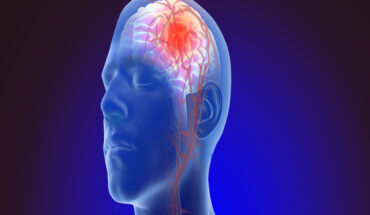 Brain Aneurysm: Causes, Symptoms & Treatment Options
