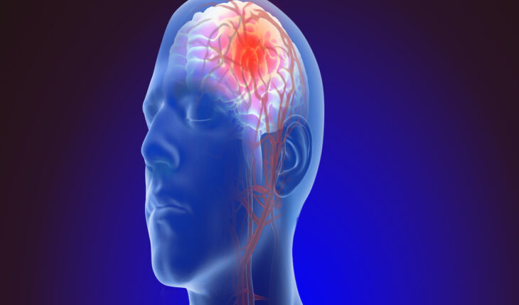 Brain Aneurysm: Causes, Symptoms & Treatment Options