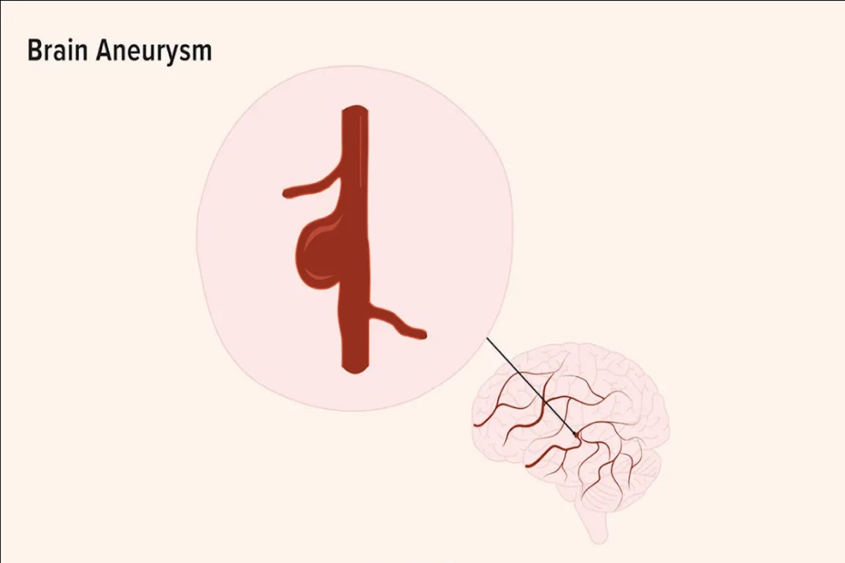 Brain Aneurysm