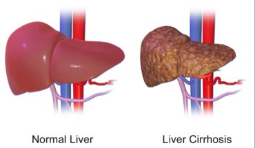 Liver Cirrhosis: Causes, Symptoms & Treatment Options