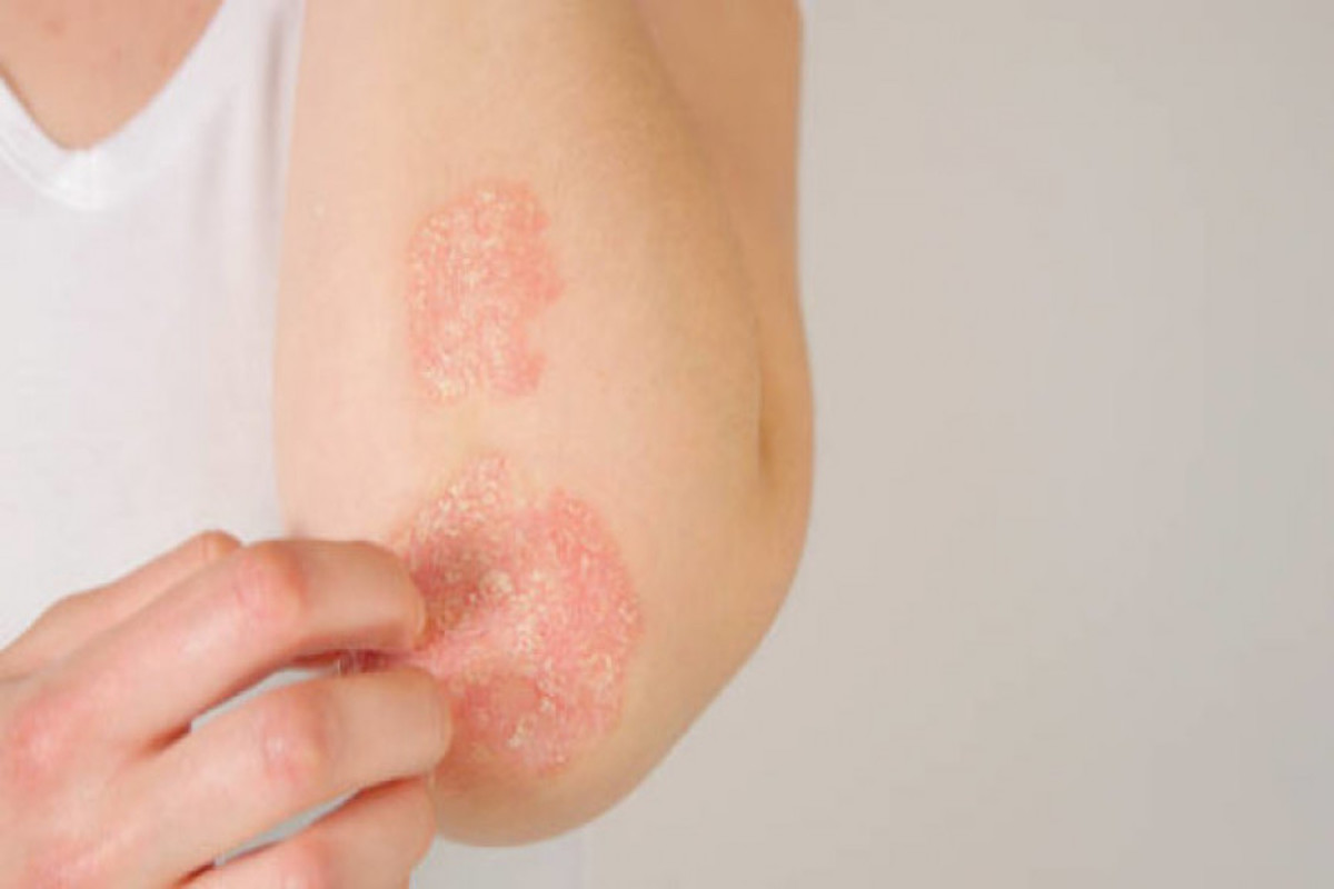 Plaque Psoriasis