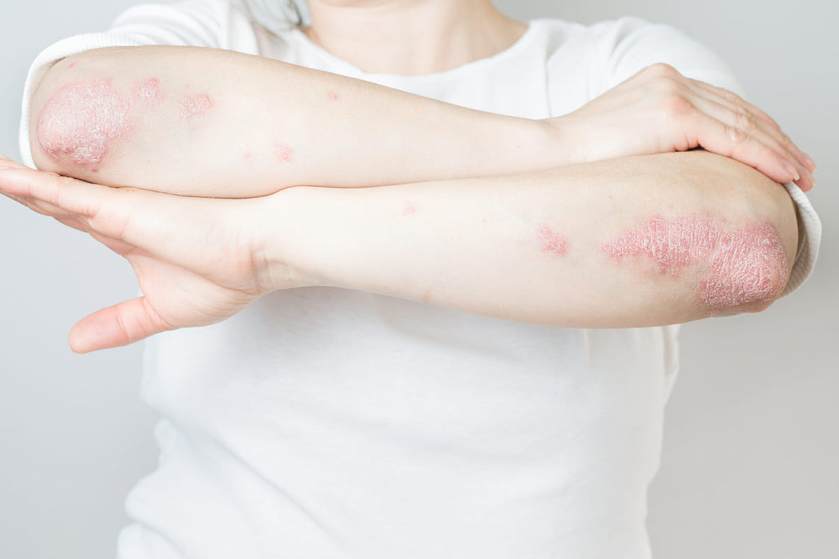 Plaque Psoriasis Causes, Triggers, Symptoms & Treatments