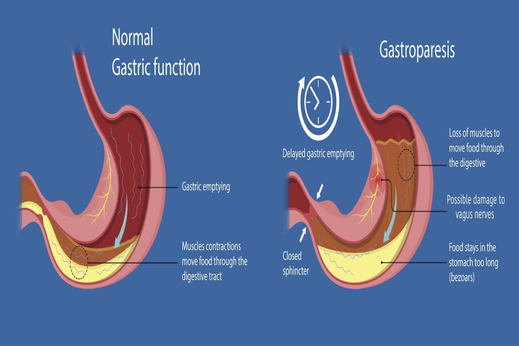 Gastroparesis Causes Symptoms And Treatment Options