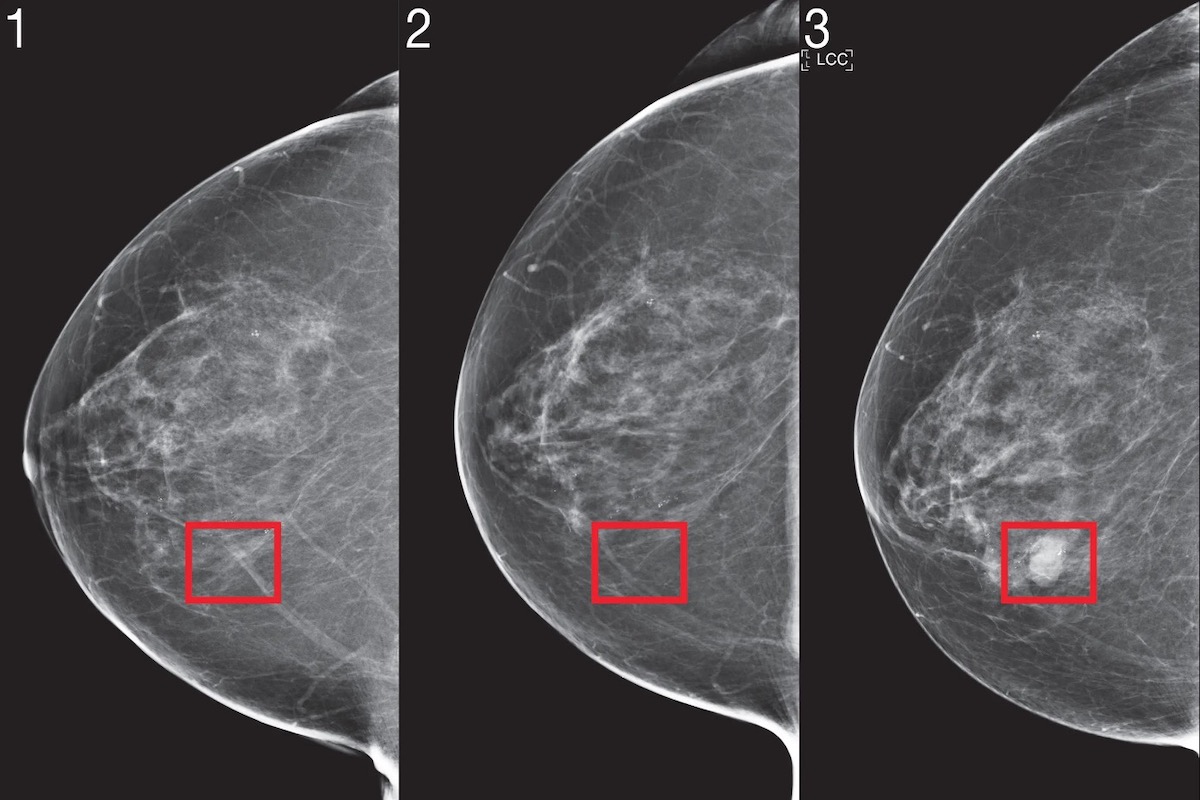 Breast Cancer Scan