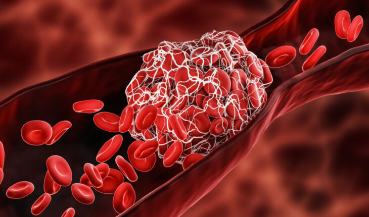 Blood Clot: Causes, Symptoms & Treatment Options