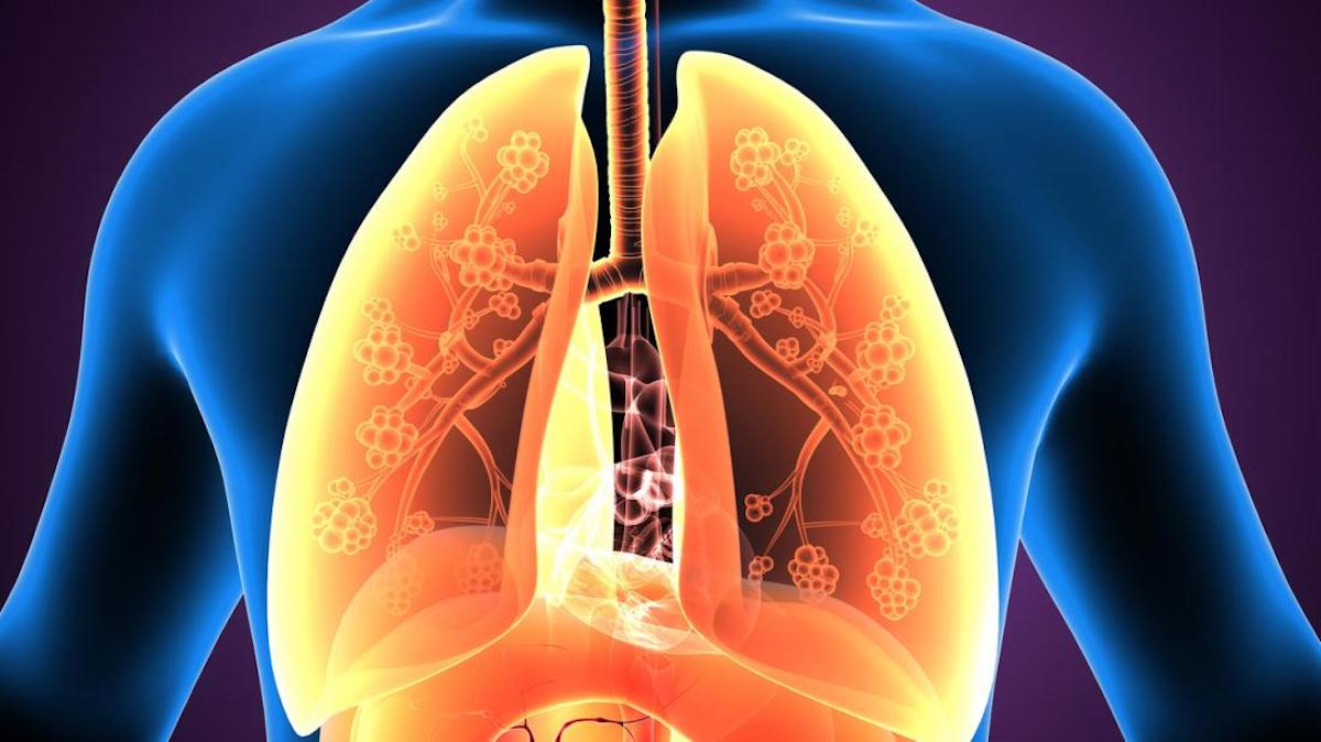 Eosinophilic Asthma