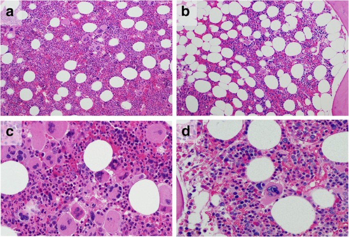 Myelofibrosis