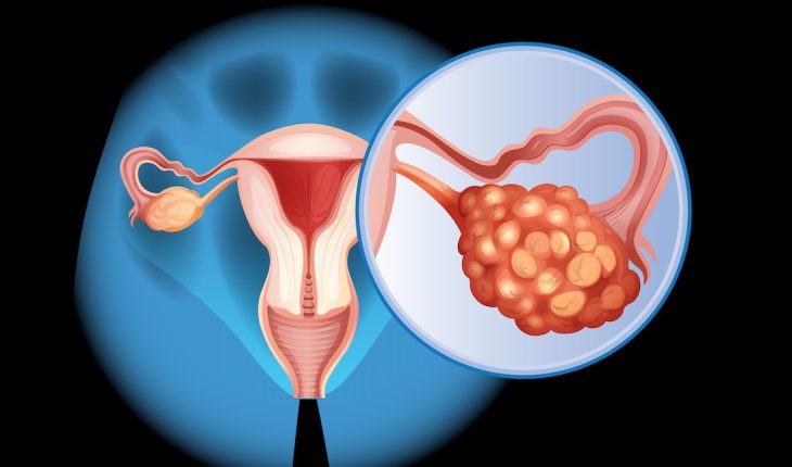 Ovarian Cancer: Stages, Symptoms & Treatment Options