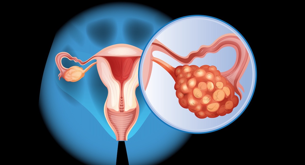 Ovarian Cancer