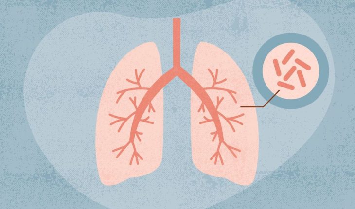 Pneumonia: Causes, Symptoms & Treatment Options