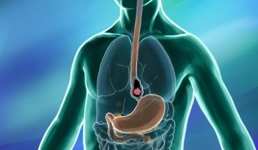 Esophageal Cancer: Causes, Symptoms & Treatment Options