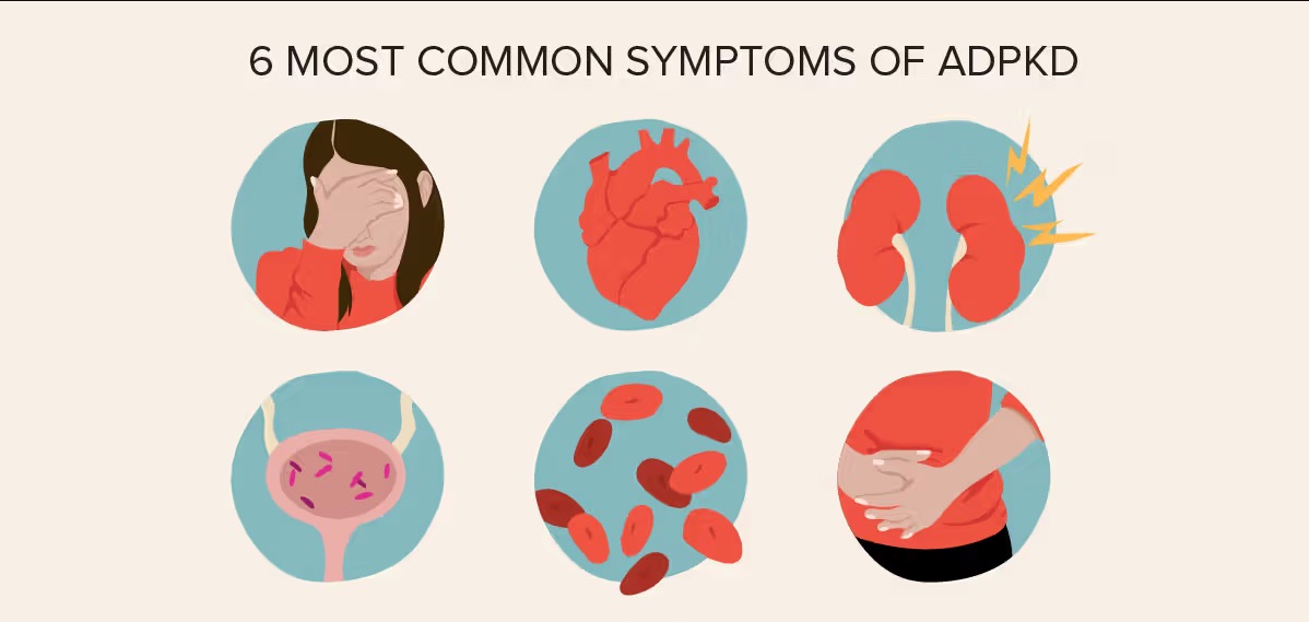 Adpkd Symptoms