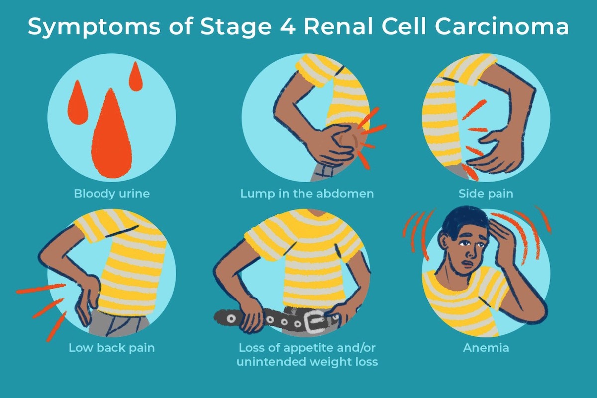 renal cancer symptoms