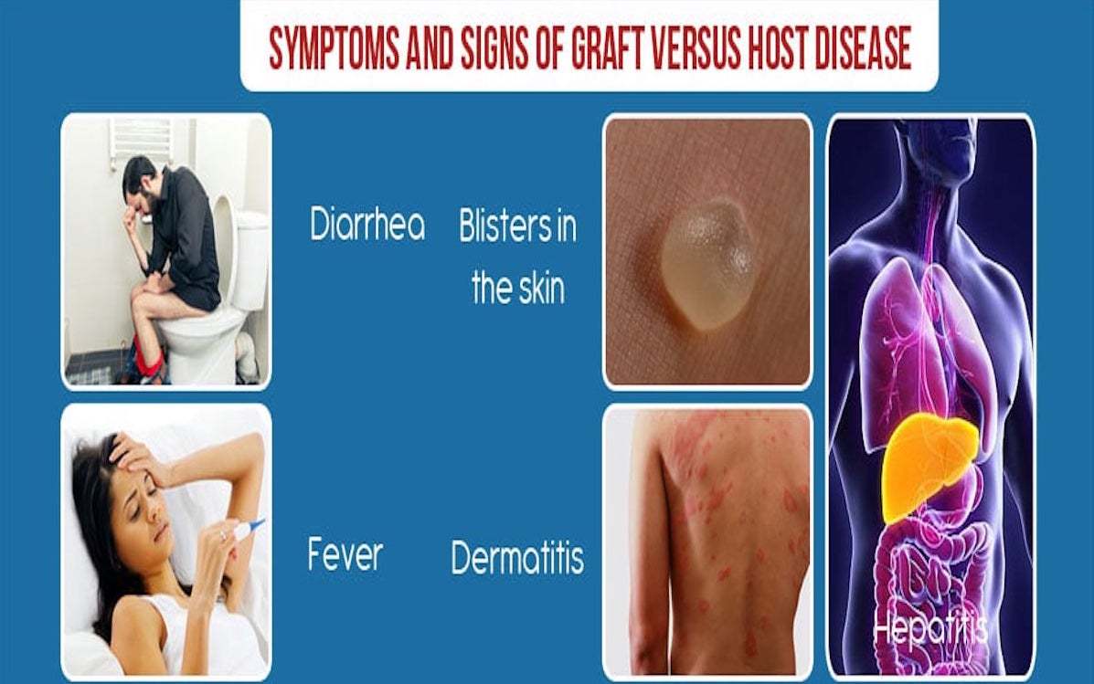 Graft versus host Disease