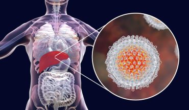 Hepatitis C: Causes, Symptoms & Treatment Options