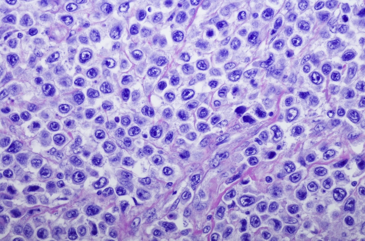 Diffuse Large B cell Lymphoma